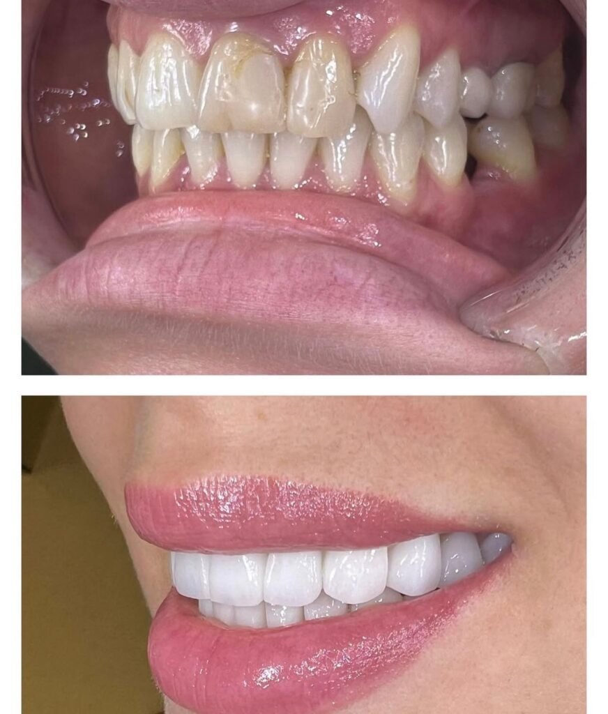 faccette professionali per pazienti italiani