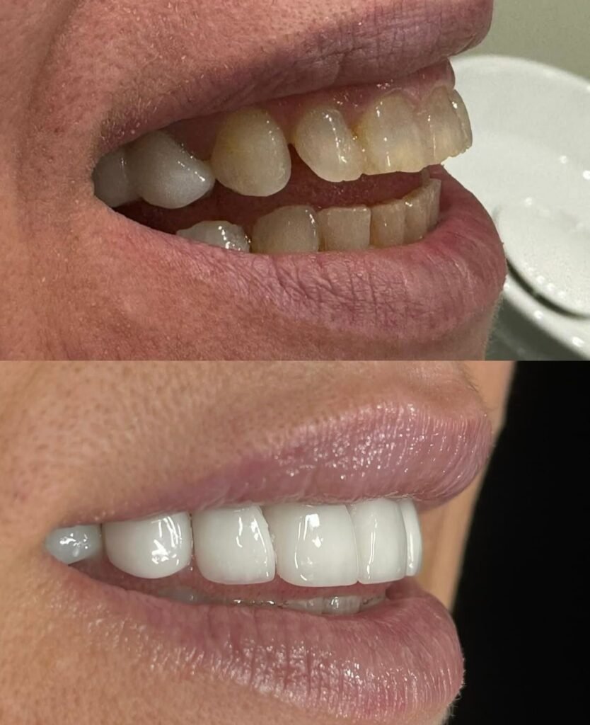 faccette professionali per pazienti italiani